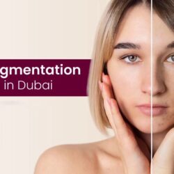 laser-pigmentation-removal-dubai
