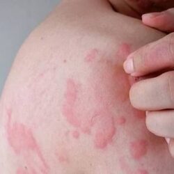 Chronic urticaria research