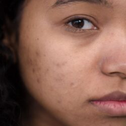 Acne Treatment in Roorkee