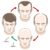 stages-hair-loss-hair-treatment600