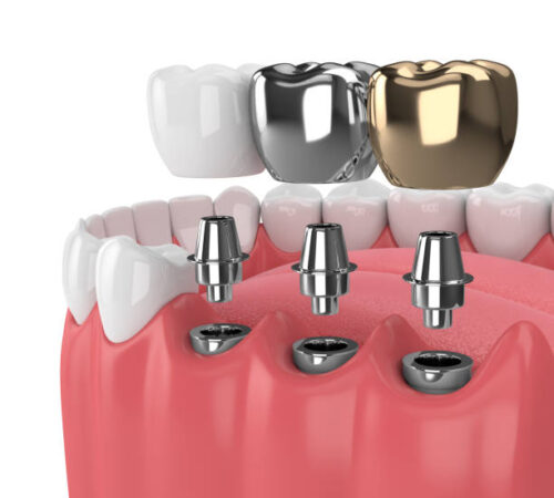 Best Dentist in Madurai for Complete Dental Care Solutions Best Dentist in Madurai for Complete Dental Care Solutions