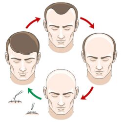 stages-hair-loss-hair-treatment600