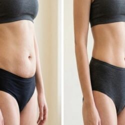 Tummy_Tuck_Dubai (1)