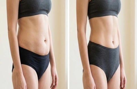 Tummy_Tuck_Dubai (1) Tummy_Tuck_Dubai (1)