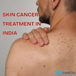 Skin Cancer Treatment in India