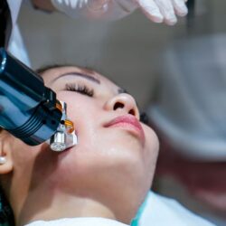 Radiofrequency Microneedling in Dubai
