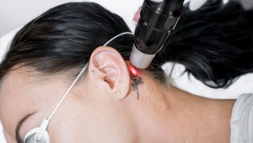 laser-tattoo-removal laser-tattoo-removal
