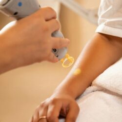 laser hair removal in Dubai