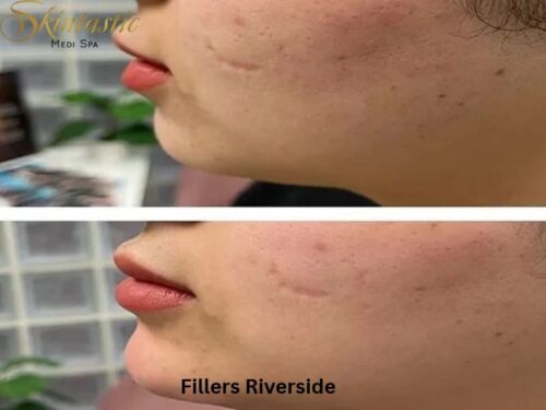 Fillers Riverside Fillers Riverside