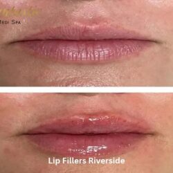 Lip Fillers Riverside