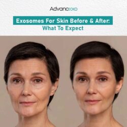 Exosomes for Skin Before and After