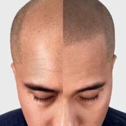 Scalp Micropigmentation (2)