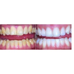 Dental Cleaning in Orangeville_ Support Healthy Teeth and Gums