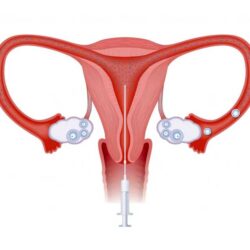 Intrauterine-Insemination-Treatment