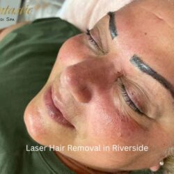Laser Hair Removal in Riverside