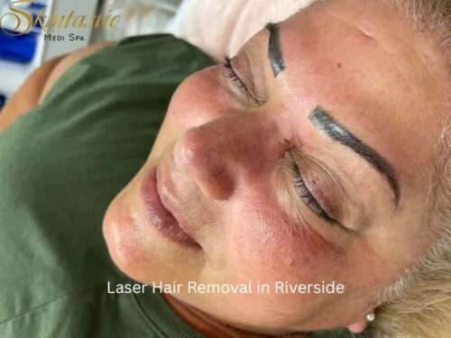 Laser Hair Removal in Riverside Laser Hair Removal in Riverside