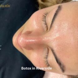 Botox in Riverside