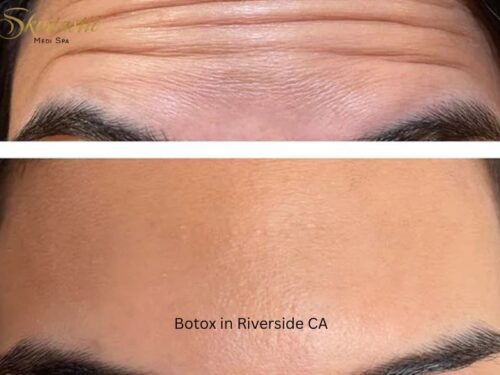 Botox in Riverside CA Botox in Riverside CA