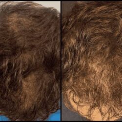 Non-Surgical Hair Loss Dallas