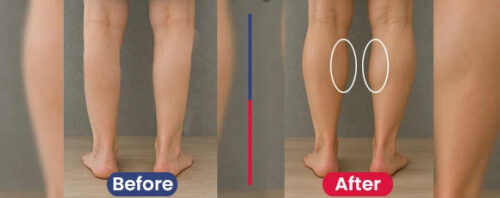 Calf Implants Turkey Calf Implants Turkey